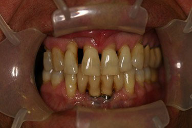 Avant pose implants dentaires 2