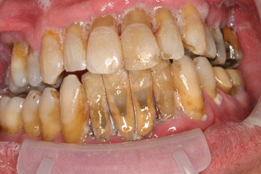 Avant pose implants dentaires