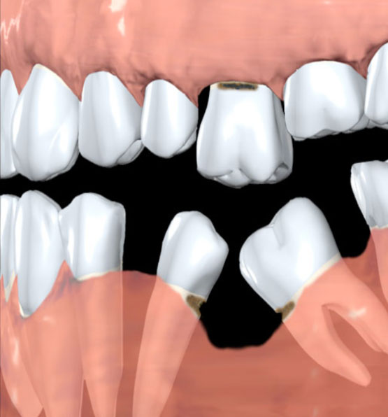 Déchaussement de dents en l'absence d'implant dentaire