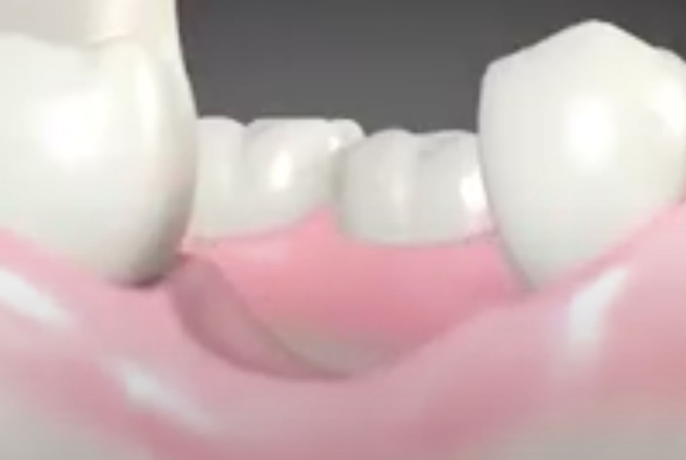 Fonte osseuse suite extraction de dent