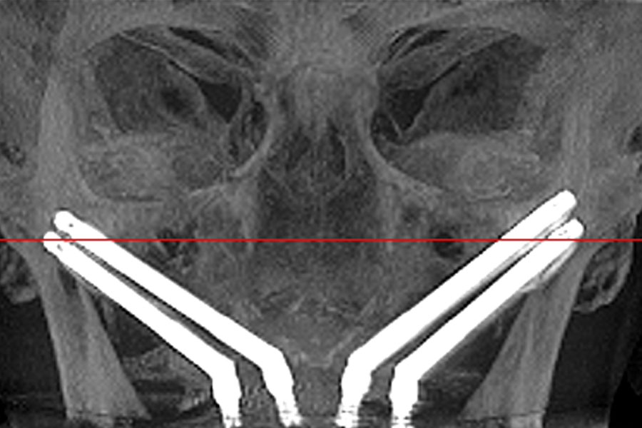 Prothèse fixe au maxillaire supérieur avec 4 implants zygomatiques