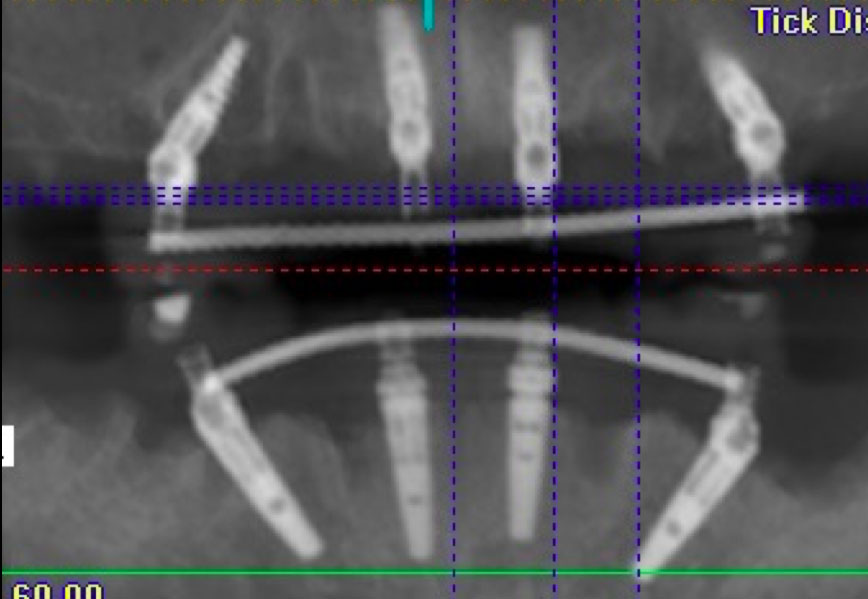 Radiographie All-on-4 implants dentaires sur deux mâchoires