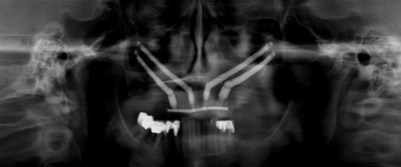 Radiographie implants dentaires All-on-4