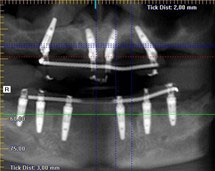 Radiographie réhabilitation complète fixe maxillaire et mandibulaire