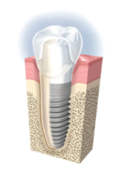 Schéma d'un implant dentaire