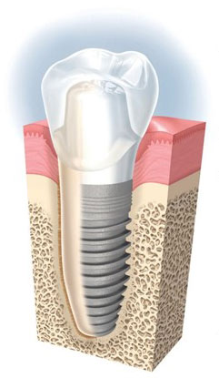 Structure implant dentaire