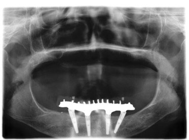 Radiographie implant dentaire All-on-4