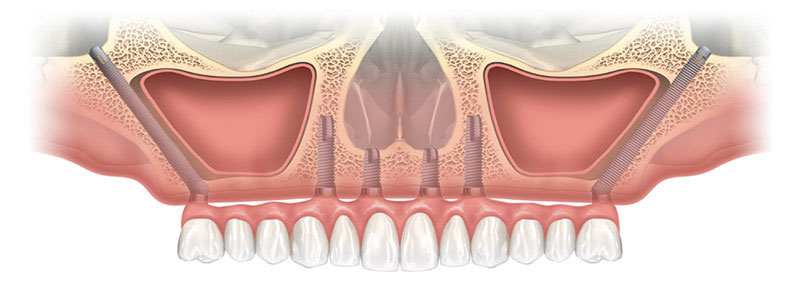 Implants zygomatiques Lyon