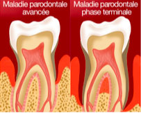 Schéma maladie parodontale